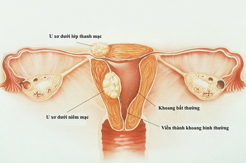 U xơ buồng trứng là một trong những nguyên nhân trực tiếp gây ra bệnh lý vô sinh đối với nữ giới