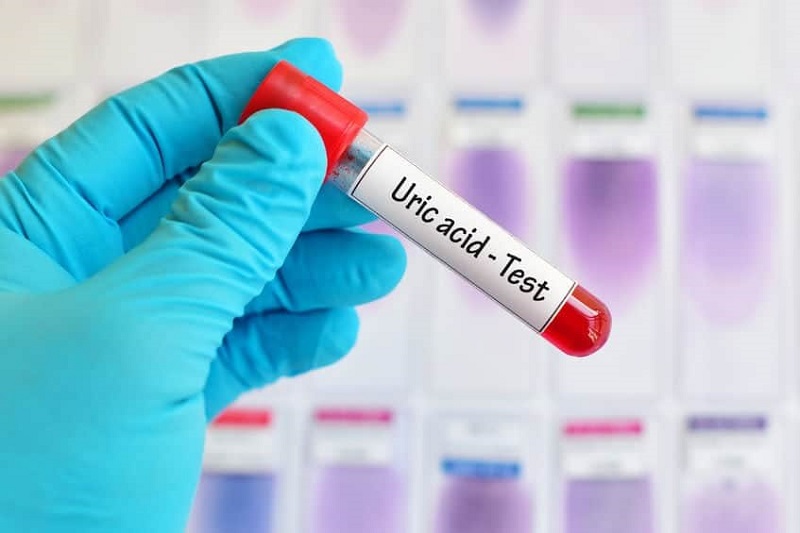Xét nghiệm nồng độ acid uric có trong máu