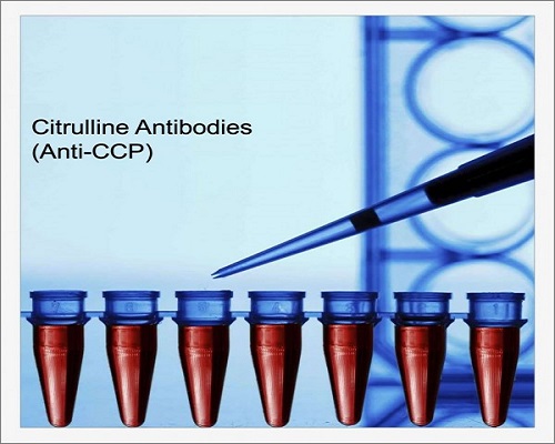 Xét nghiệm Anti-CCP chẩn đoán bệnh viêm khớp dạng thấp