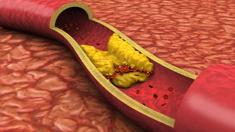 Cholesterol tăng cao gây xơ vữa động mạch