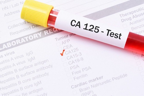 xét nghiệm CA 125 hỗ trợ phát hiện và chẩn đoán 1 số bệnh lý