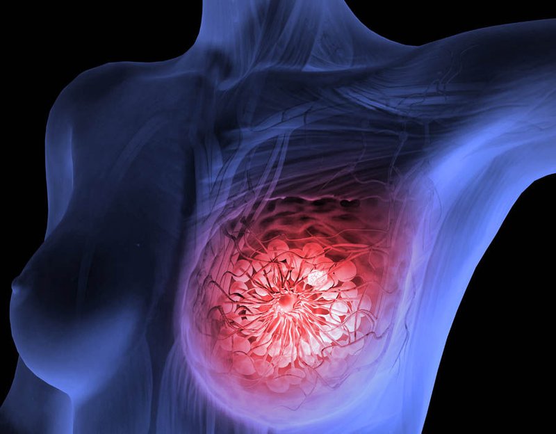 Giá trị CA 15-3 có độ nhạy chẩn đoán khi ung thư vú di căn lên đến 91%