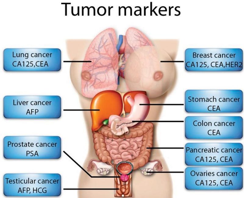 Nhiều khối u và ung thư gây tăng nồng độ CEA