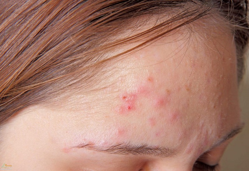 Các triệu chứng của bệnh viêm da Demodex là cảm giác kiến bò trên mặt