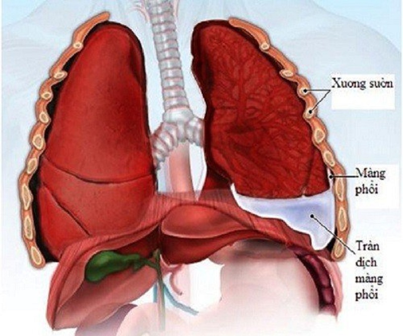 Hiện tượng tràn dịch màng phổi