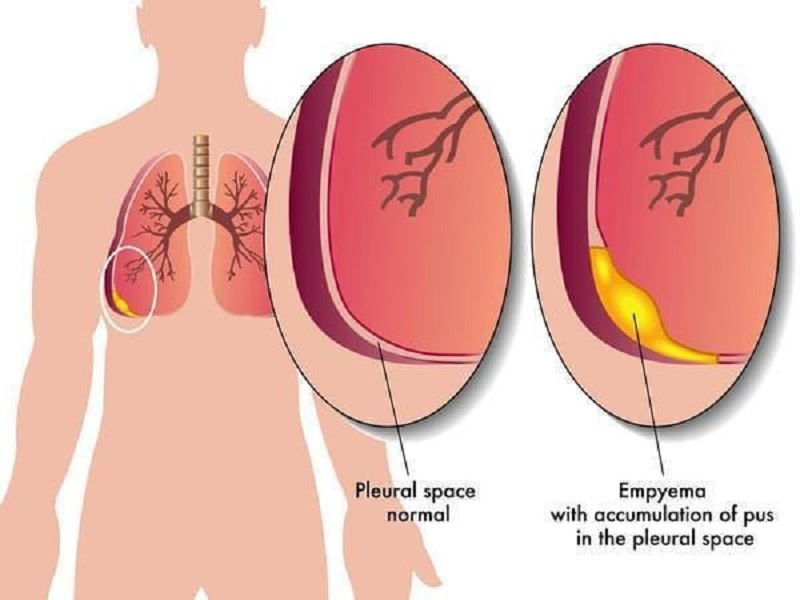 Màu sắc dịch màng phổi góp phần xác định nguyên nhân gây bệnh