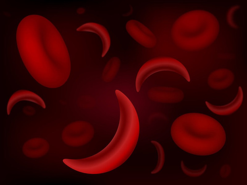 Biến thể hemoglobin S gây nên bệnh hồng cầu hình lưỡi liềm