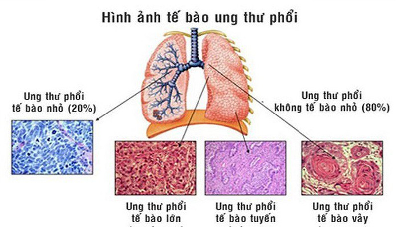 Hình ảnh tế bào ung thư phổi