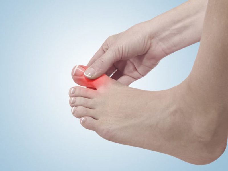 Triệu chứng sưng ngón chân cái của bệnh Gout