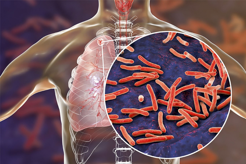 Vi khuẩn Mycobacterium tuberculosis gây bệnh lao 