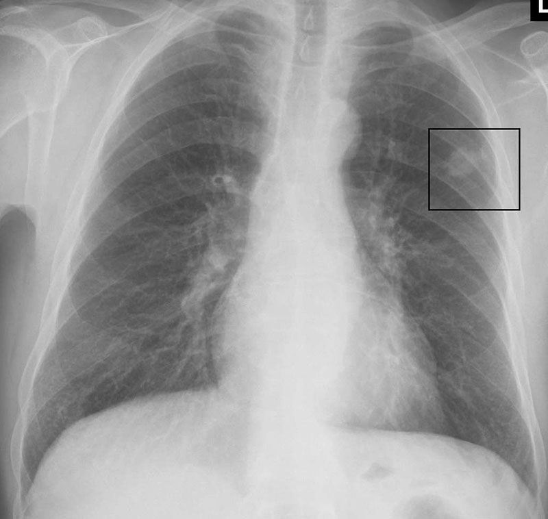 Hình ảnh X quang bệnh nhân bị lao nốt