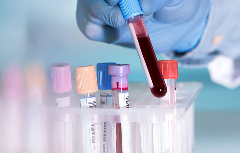 Xét nghiệm máu là một phương pháp chẩn đoán bệnh xơ gan