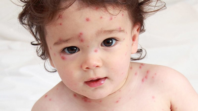 Bệnh thủy đậu thường xảy ra ở trẻ em 