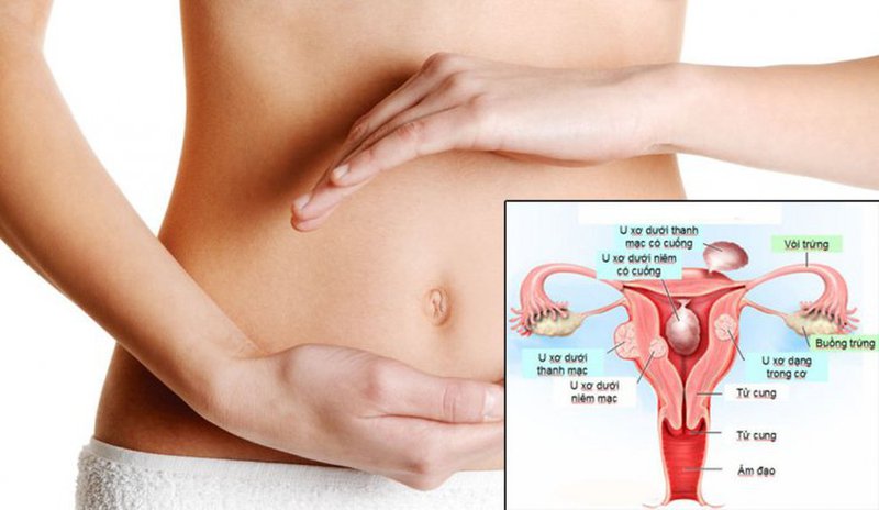 Chị em phụ nữ nên đi xét nghiệm u xơ tử cung khi bị đau bụng âm ỉ, kéo dài vùng hạ vị (vùng dưới rốn) có hoặc không có dấu hiệu cường kinh, rong kinh