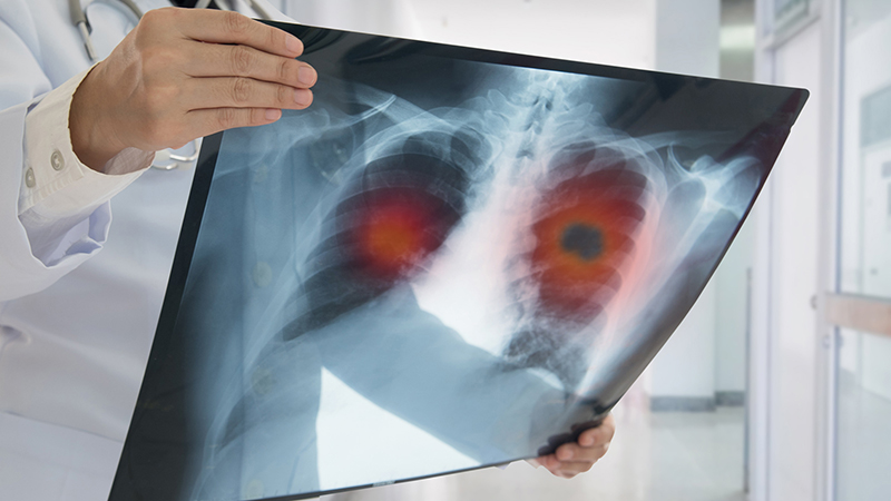 Chụp X - quang cho phổi là phương pháp đơn giản dùng để phát hiện các dấu hiệu bất thường hay các khối u tại vùng phổi
