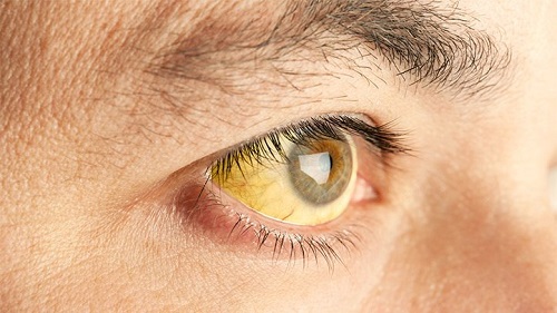nếu không được chẩn đoán, theo dõi và điều trị thì vàng mắt sẽ là biến chứng của viêm gan C