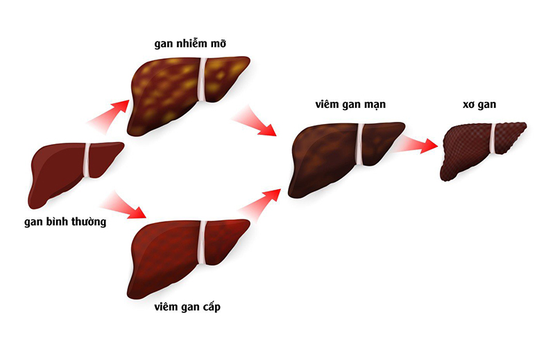 Hình ảnh minh họa cho các giai đoạn của xơ gan