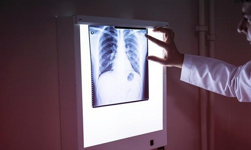 Kỹ thuật chụp X-quang tim phổi tại MEDLATEC