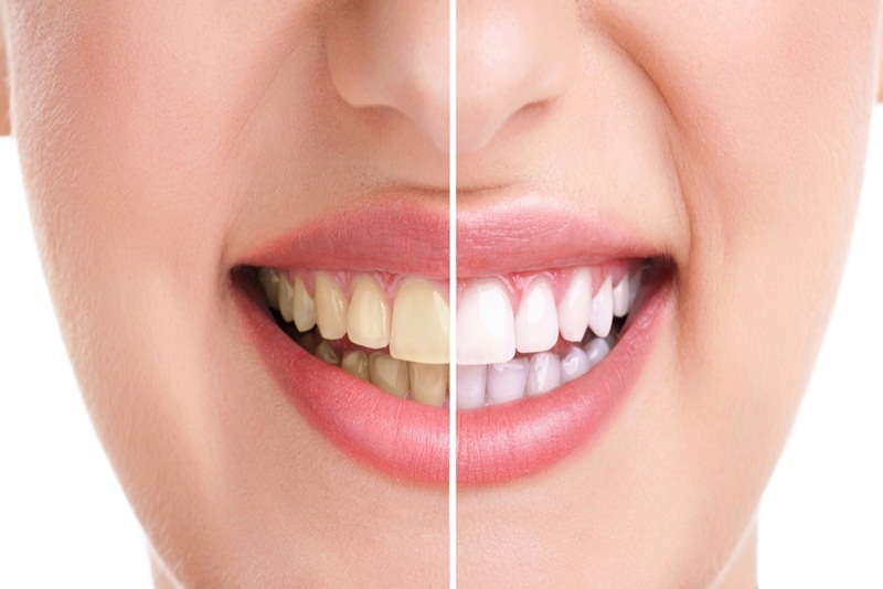 Chỉ điểm” các nguyên nhân khiến răng bị xỉn màu