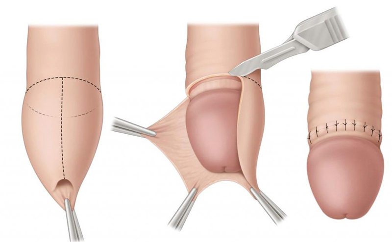 Vị trí của gây tê khi cắt bao quy đầu là ở đâu?
