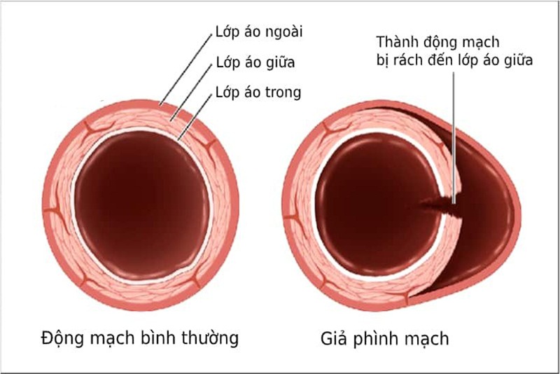 Dẫn phình tĩnh mạch cảnh ở cổ có nguy hiểm không?
