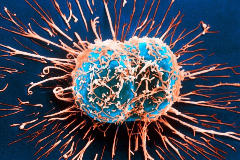 Ung thư di căn là gì và tại sao nó xảy ra?
