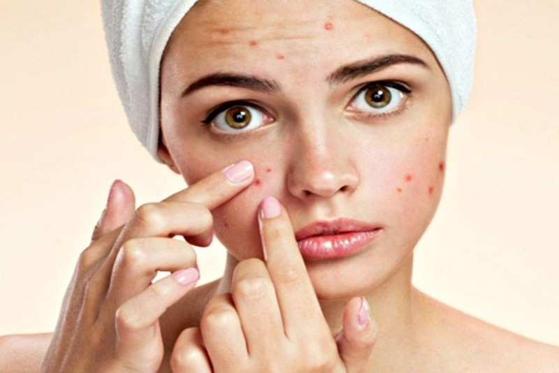 Người có da nhờn và mụn có thể sử dụng collagen không?
