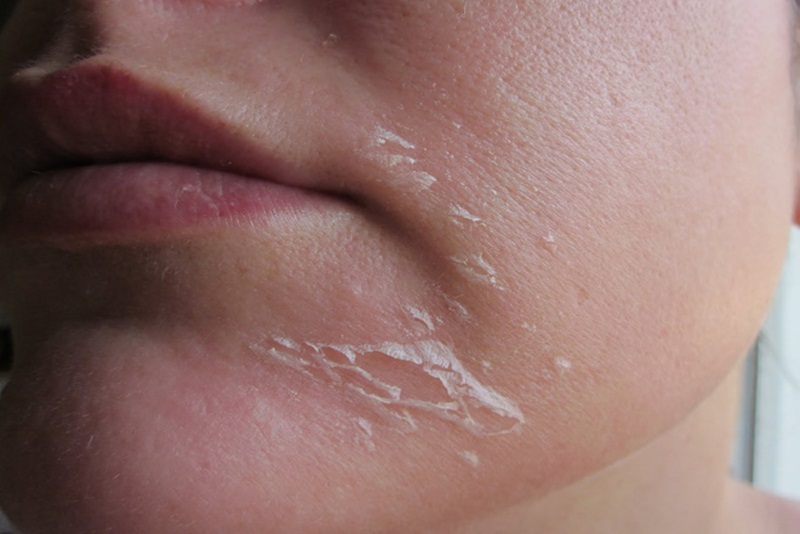 Làm thế nào để chăm sóc da mặt khi bị khô ngứa và tróc vảy?
