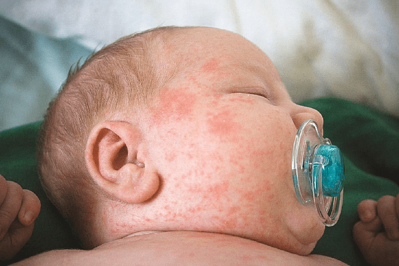 Nguyên nhân và cách bệnh sởi sốt phát ban ở trẻ phòng ngừa