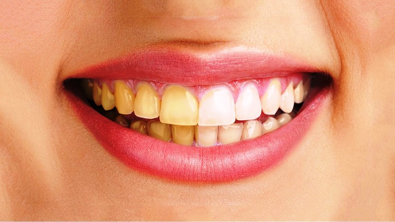 Răng ố vàng: nguyên nhân và cách khắc phục hiệu quả tại nhà