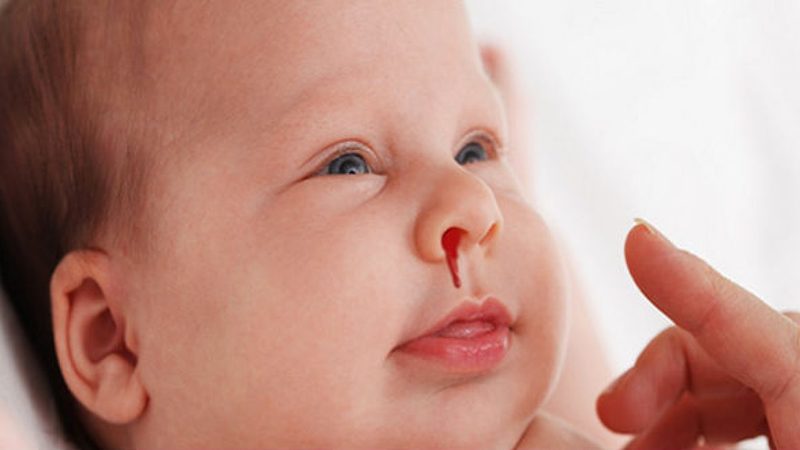 Nguyên nhân và cách xử lý chảy máu mũi thiếu chất gì 