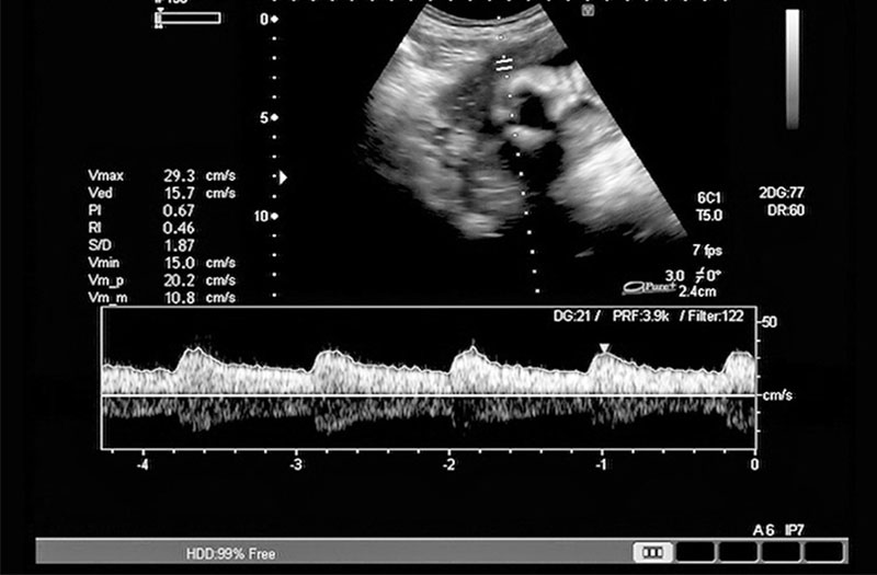 Khi nào tim thai bắt đầu phát triển trong tử cung của mẹ?

