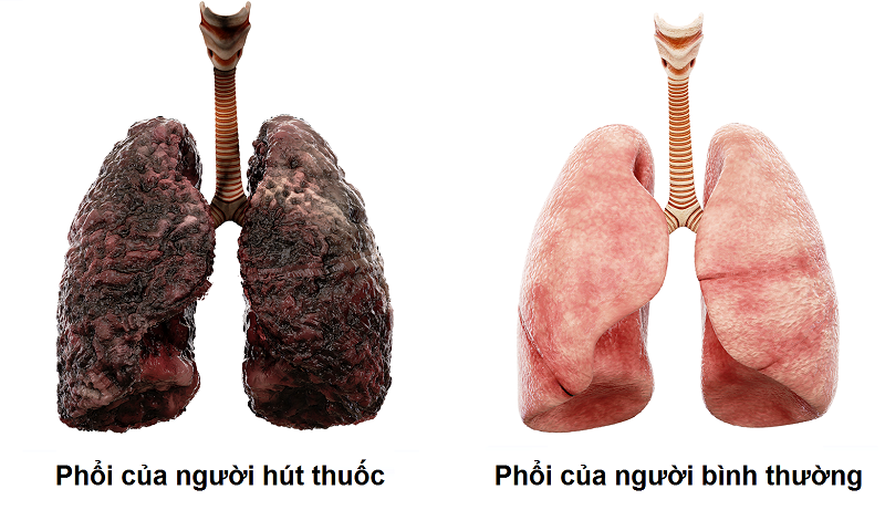 3. Triệu chứng của các bệnh liên quan đến phổi bị đen