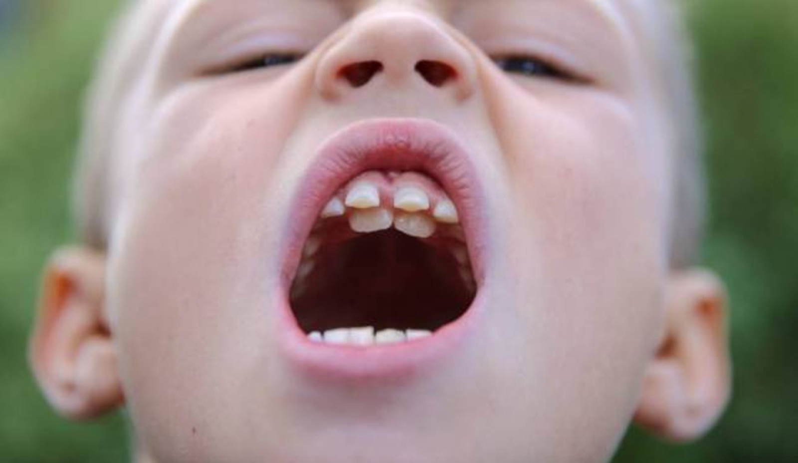  Răng hàm dưới mọc lệch ra ngoài - Tìm hiểu về công dụng đặc biệt của răng mực