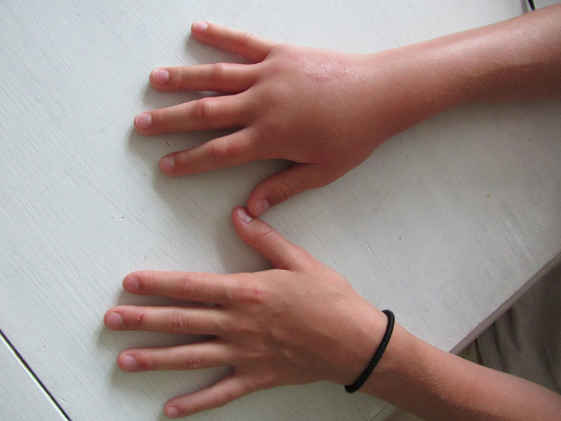 Những biến chứng nghiêm trọng có thể xảy ra do nhức ngón tay không được điều trị đúng cách là gì?