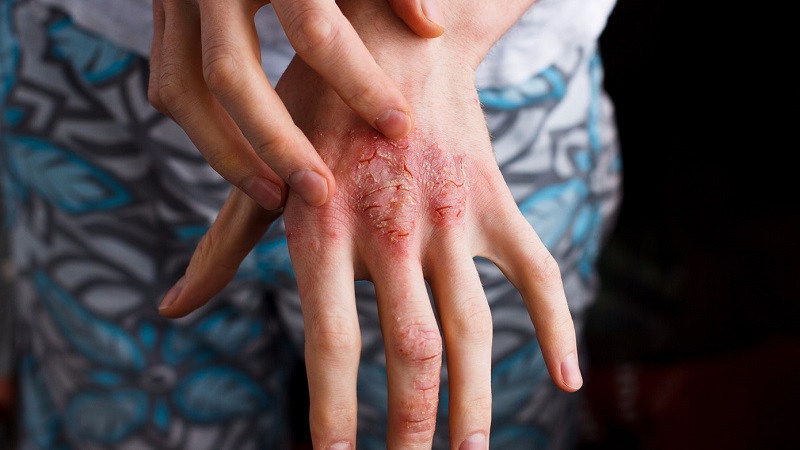 Nguyên nhân bị viêm da là gì?