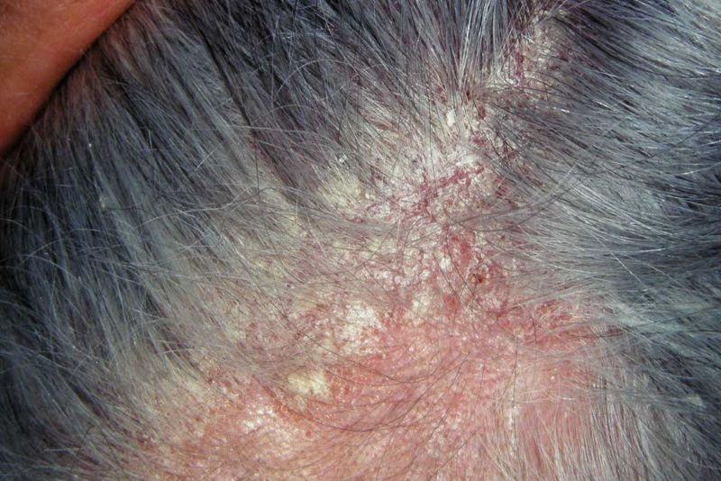 Cách trị nấm da đầu tại nhà bằng chanh có hiệu quả không?