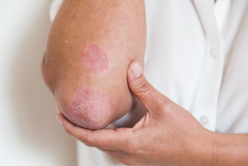 Bệnh bệnh chàm da có lây không - Nguyên nhân, triệu chứng và cách phòng tránh