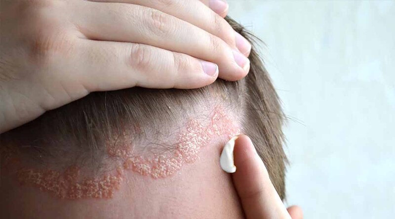 Các bệnh về da đầu phổ biến là gì?