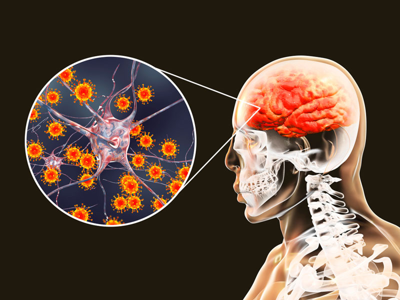 Có phải đau đầu là triệu chứng thường gặp ở viêm não?
