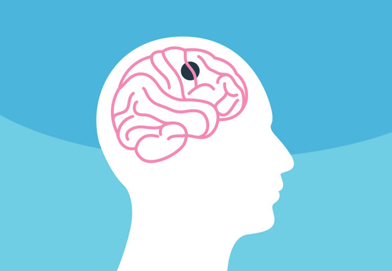 Tỷ lệ bệnh nhân u não có triệu chứng đau đầu trầm trọng là bao nhiêu?
