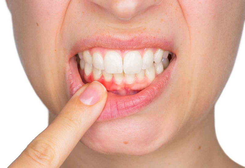 Tụt lợi có ảnh hưởng đến sức khỏe răng miệng như thế nào?
