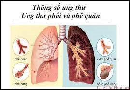 UNG THƯ PHỔI CÓ THỂ ĐIỀU TRỊ TÙY THEO GIAI ĐOẠN VÀ TÌNH TRẠNG BỆNH NHÂN