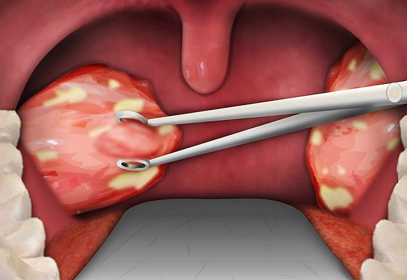 Amidan mãn tính có cần phẫu thuật cắt không?