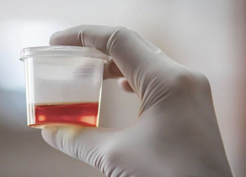 Đi tiểu ra máu có liên quan đến tình trạng sức khỏe nội tạng không?
