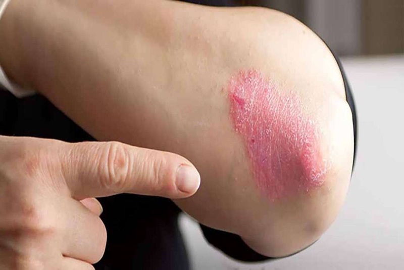 Bệnh hắc lào bị nấm da có triệu chứng như thế nào?