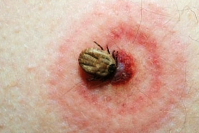 Triệu chứng và cách chẩn đoán bệnh lyme một bệnh lý do ký sinh trùng gây ra