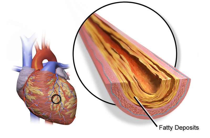 Các biểu hiện của thiếu máu cơ tim 