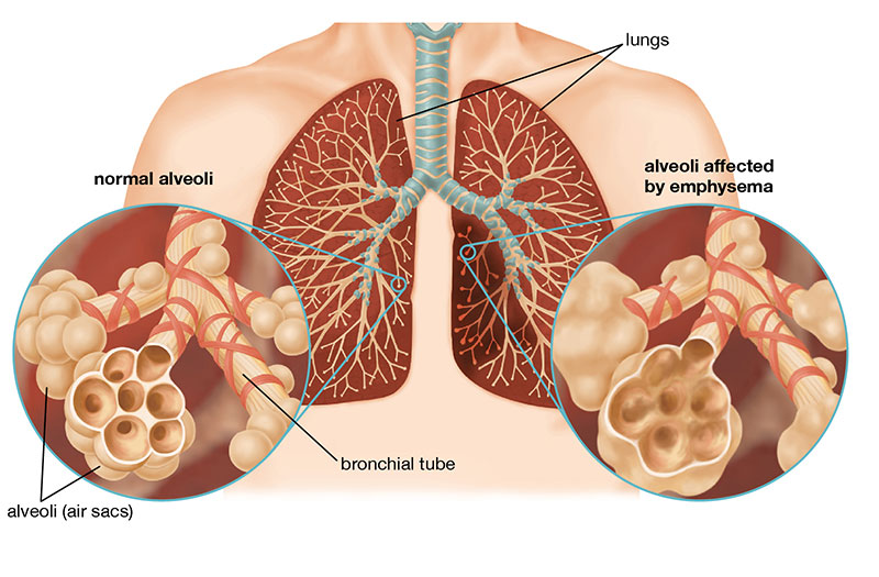 Bệnh phổi tắc nghẽn mạn tính có lây qua đường nhiễm trùng không?
