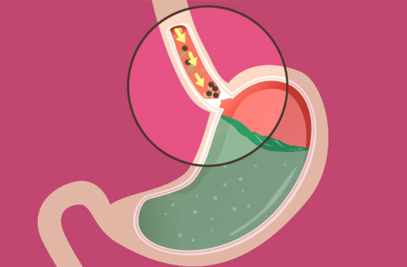 Cách chăm sóc bệnh nhân trào ngược dạ dày thực quản và cách điều trị